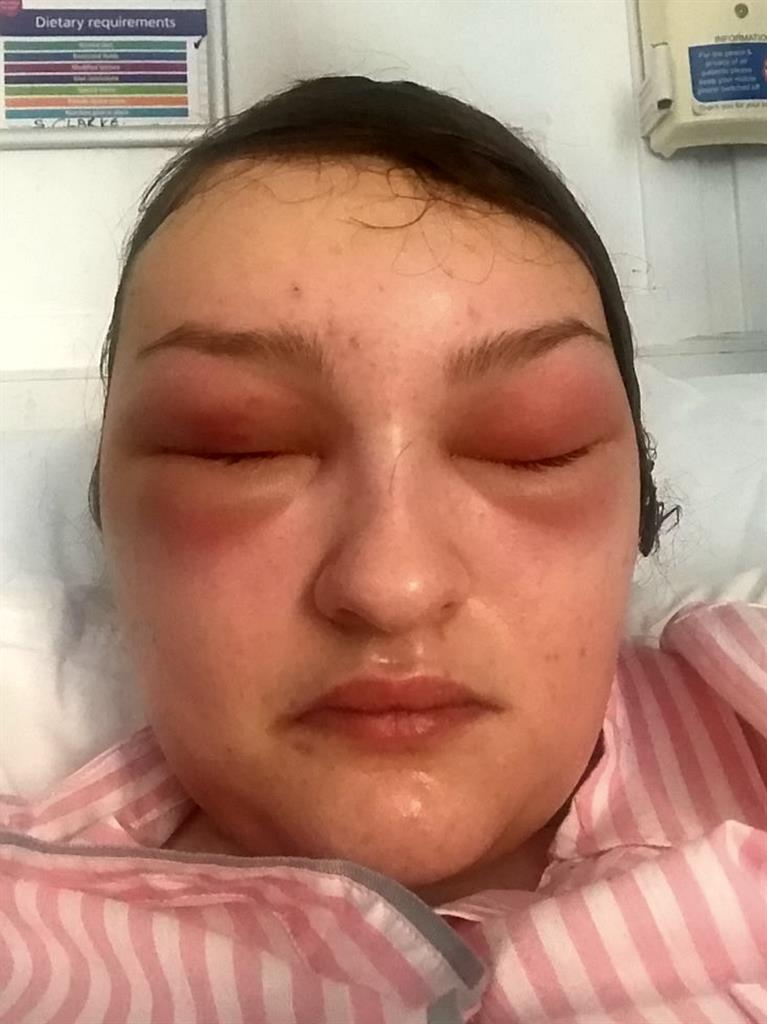 'Horrible': Megan said the worst part after the operation was when her eyes swelled themselves completely shut PICTURES: MEGAN BARKER/SWNS