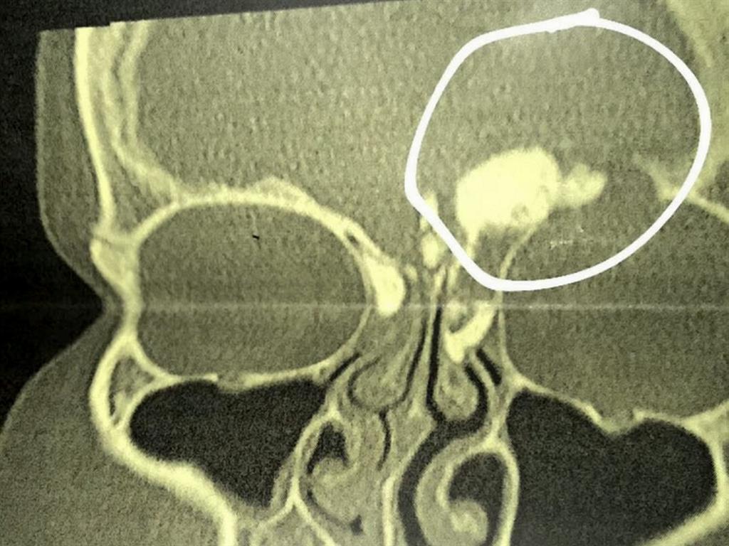 Pressing time: A scan of Megan's head revealed the tumour (circled) in her sinus