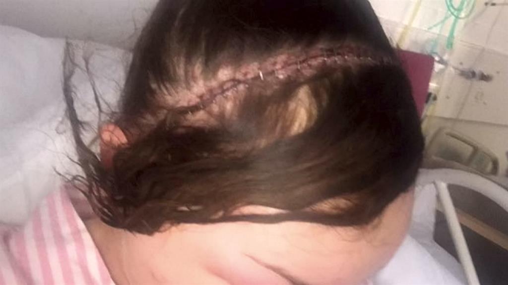 Serious op: Doctors carried out a procedure which meant peeling back Megan's face so that they could remove the mass