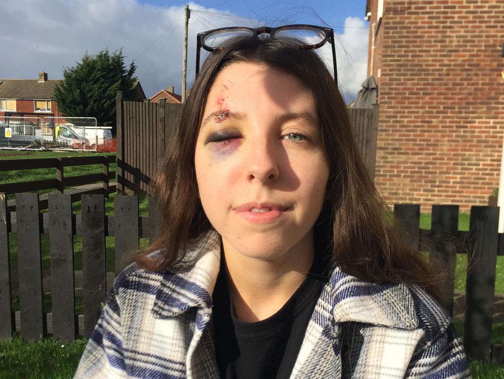 Injured: Erin Jennings shows her bruised right eye. She also has a suspected broken rib PICTURE: PA