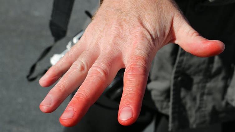 Frostbite: It also reduces blood flow to help organs stay warm PICTURE: TOME213/SHUTTERSTOCK